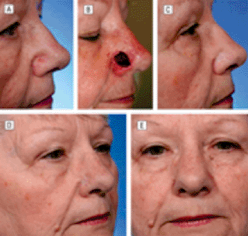 Image: Example of nasal alar reconstruction using the new technique (Photo courtesy of the University of Michigan Comprehensive Cancer Center).